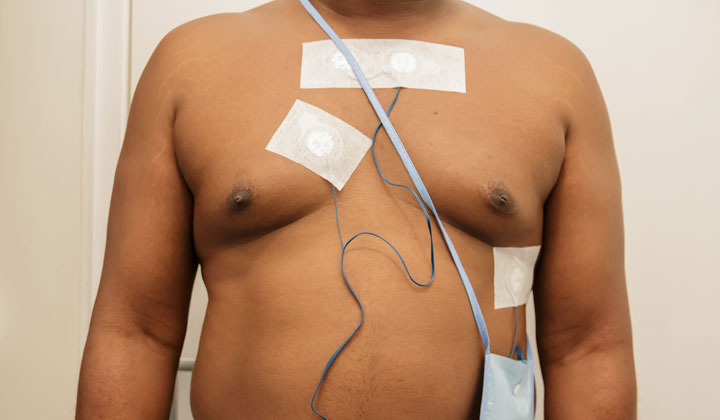 Holter-registratie: 24- of 48 uurs hartfilmpje